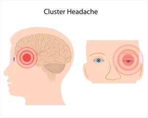 cluster Headaches