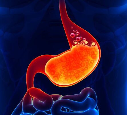 stomach acid reflux